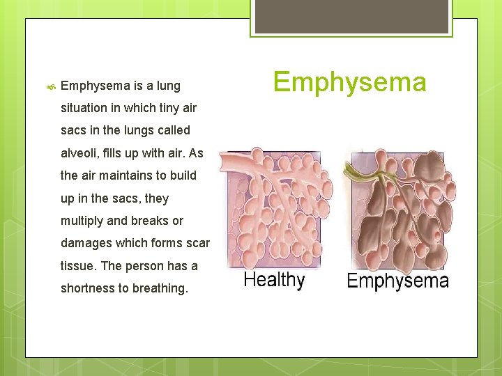  Emphysema is a lung situation in which tiny air sacs in the lungs