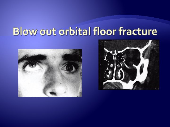 Blow out orbital floor fracture 