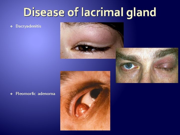 Disease of lacrimal gland v Dacryadenitis v Pleomorfic adenoma 