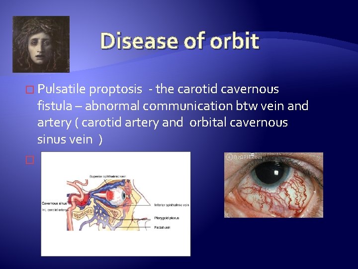 Disease of orbit � Pulsatile proptosis - the carotid cavernous fistula – abnormal communication
