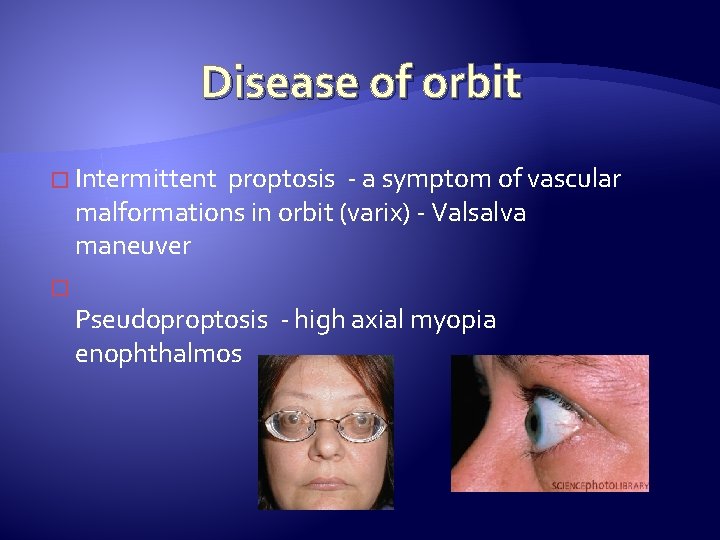 Disease of orbit � Intermittent proptosis - a symptom of vascular malformations in orbit