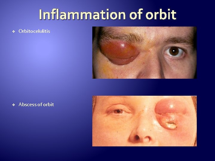 Inflammation of orbit v Orbitocelulitis v Abscess of orbit 