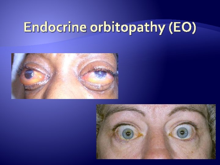 Endocrine orbitopathy (EO) 