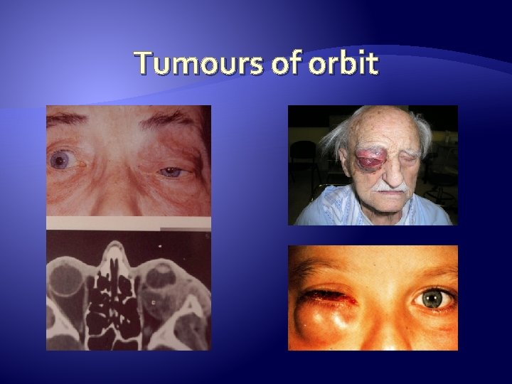 Tumours of orbit 