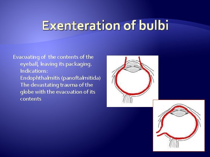 Exenteration of bulbi Evacuating of the contents of the eyeball, leaving its packaging. Indications: