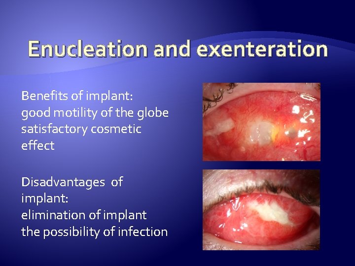 Enucleation and exenteration Benefits of implant: good motility of the globe satisfactory cosmetic effect