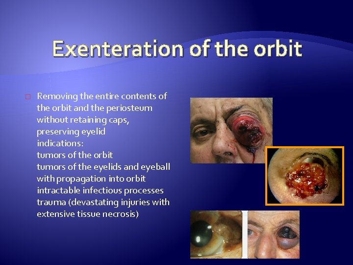 Exenteration of the orbit � Removing the entire contents of the orbit and the