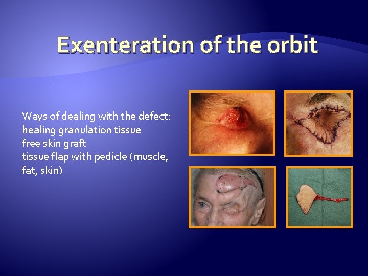 Exenteration of the orbit Ways of dealing with the defect: healing granulation tissue free