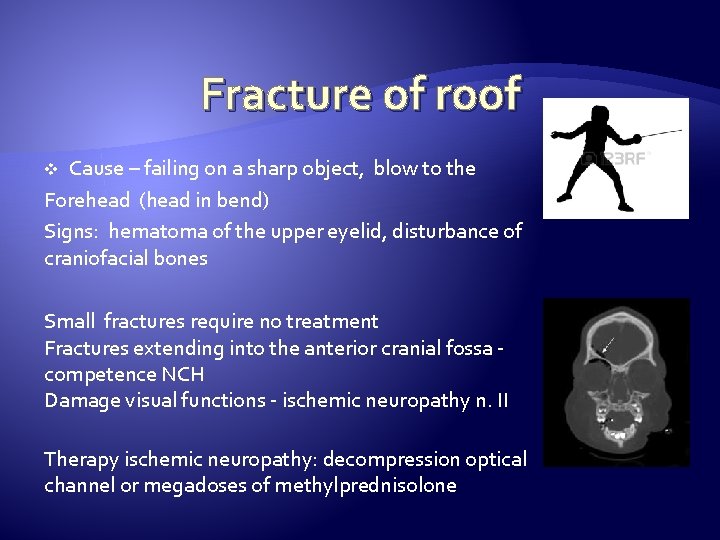 Fracture of roof Cause – failing on a sharp object, blow to the Forehead