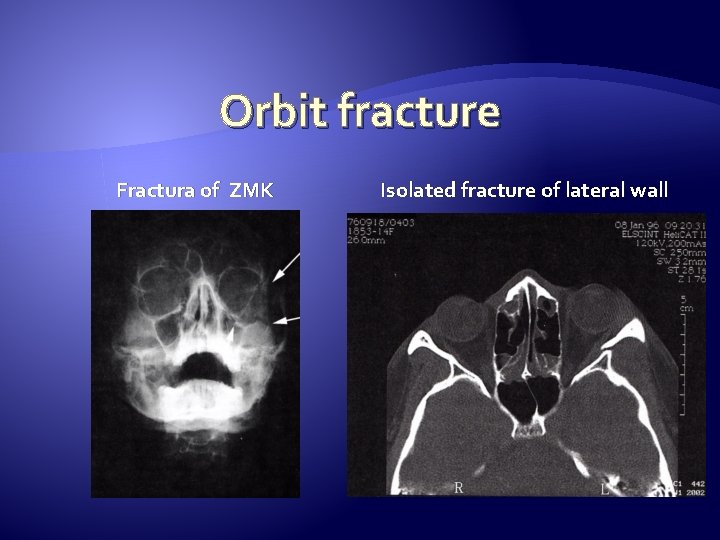 Orbit fracture Fractura of ZMK Isolated fracture of lateral wall 