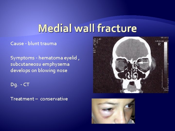 Medial wall fracture Cause - blunt trauma Symptoms - hematoma eyelid , subcutaneosu emphysema