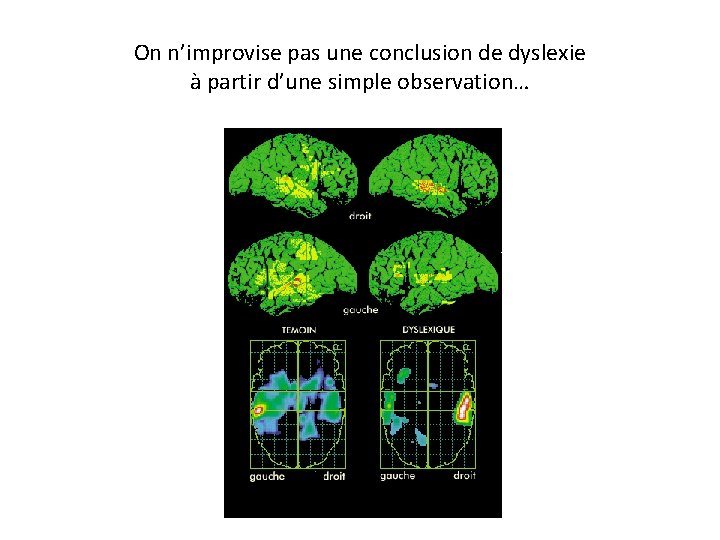 On n’improvise pas une conclusion de dyslexie à partir d’une simple observation… 