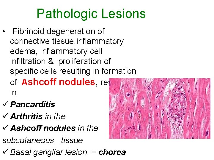 Pathologic Lesions • Fibrinoid degeneration of connective tissue, inflammatory edema, inflammatory cell infiltration &