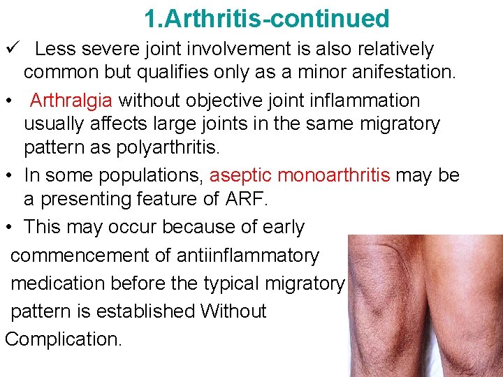 1. Arthritis-continued ü Less severe joint involvement is also relatively common but qualifies only