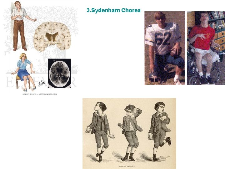 3. Sydenham Chorea 