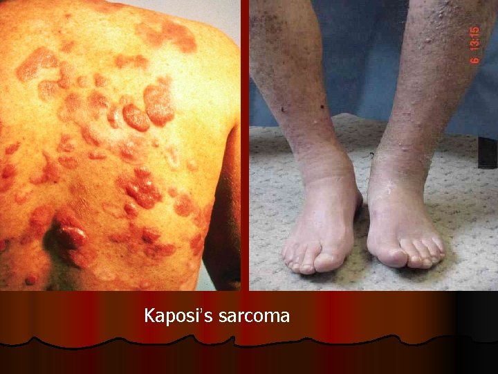 Kaposi’s sarcoma 