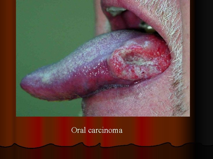 Oral carcinoma 
