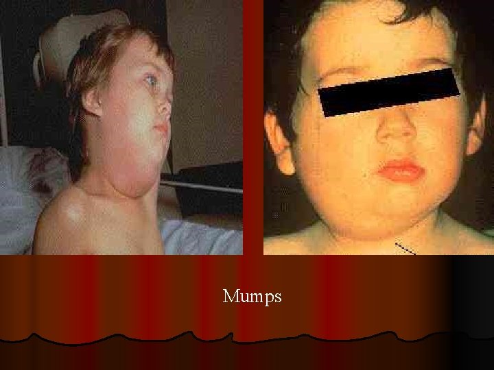 Mumps 