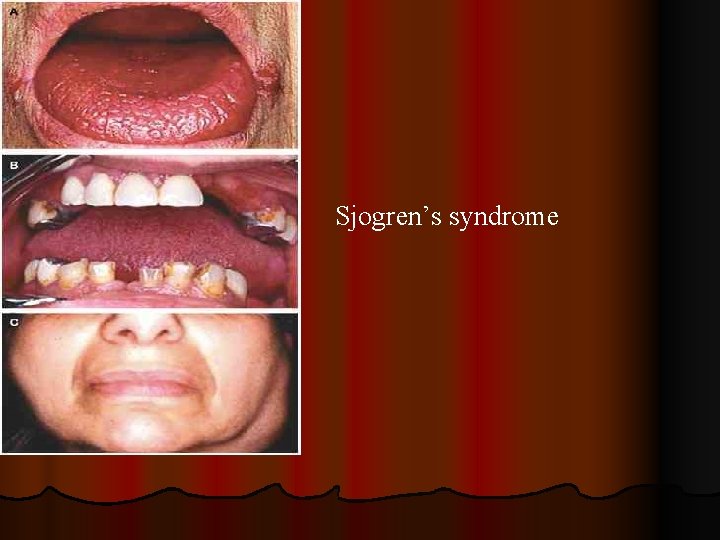 Sjogren’s syndrome 