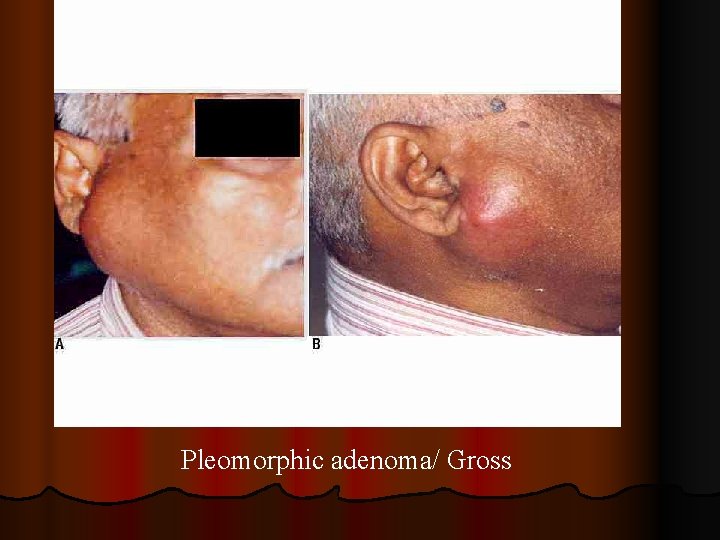 Pleomorphic adenoma/ Gross 