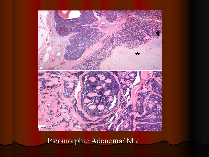Pleomorphic Adenoma/ Mic 