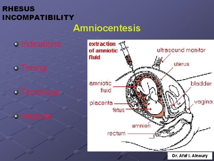 RHESUS INCOMPATIBILITY Amniocentesis Indications: Timing: Technique: Hazards: Dr. Afaf I. Alnoury 