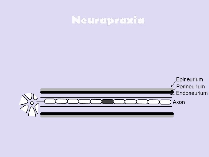 Neurapraxia 