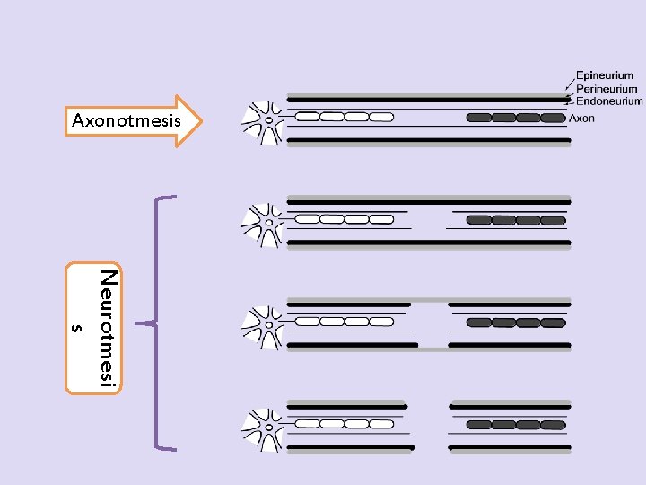 Axonotmesis Neurotmesi s 