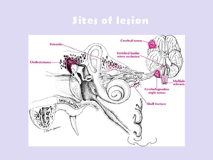 Sites of lesion 