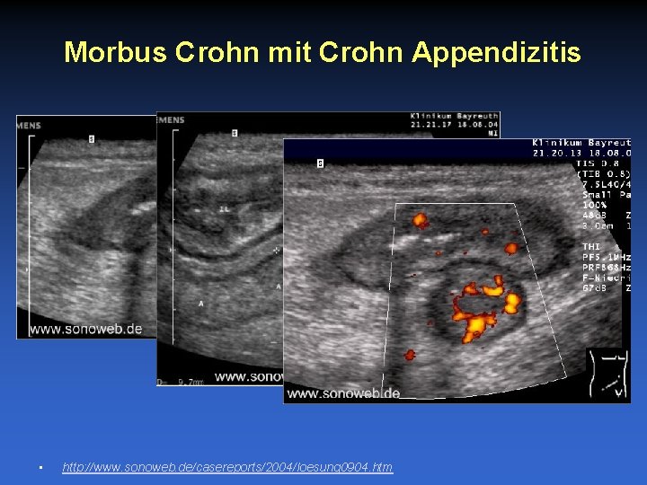 Morbus Crohn mit Crohn Appendizitis • http: //www. sonoweb. de/casereports/2004/loesung 0904. htm 
