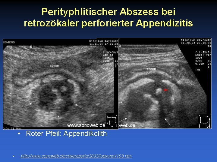 Perityphlitischer Abszess bei retrozökaler perforierter Appendizitis • Roter Pfeil: Appendikolith • http: //www. sonoweb.