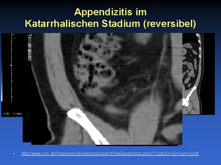 Appendizitis im Katarrhalischen Stadium (reversibel) • http: //www. cox. at/Programm. Verzeichnis. Case. Of. The.
