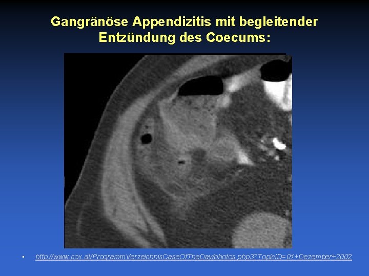 Gangränöse Appendizitis mit begleitender Entzündung des Coecums: • http: //www. cox. at/Programm. Verzeichnis. Case.