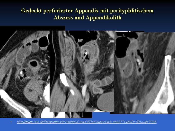 Gedeckt perforierter Appendix mit perityphlitischem Abszess und Appendikolith • http: //www. cox. at/Programm. Verzeichnis.