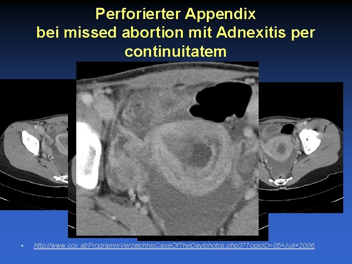 Perforierter Appendix bei missed abortion mit Adnexitis per continuitatem • http: //www. cox. at/Programm.