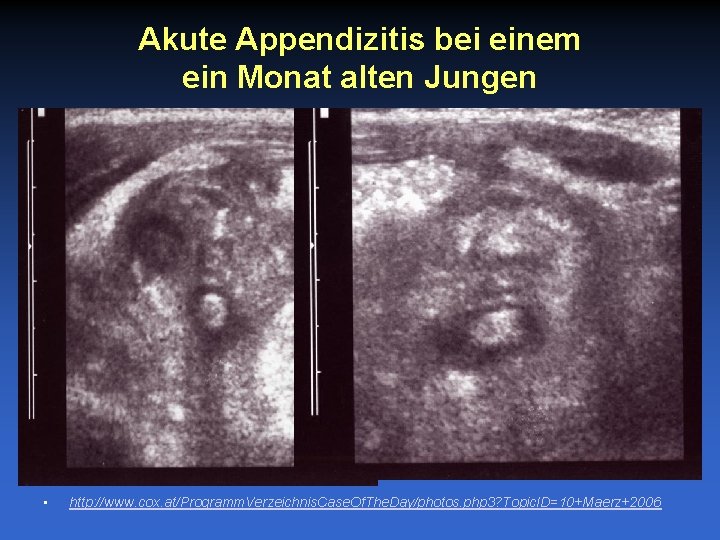 Akute Appendizitis bei einem ein Monat alten Jungen • http: //www. cox. at/Programm. Verzeichnis.