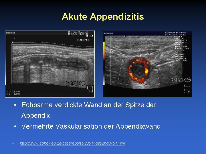 Akute Appendizitis • Echoarme verdickte Wand an der Spitze der Appendix • Vermehrte Vaskularisation