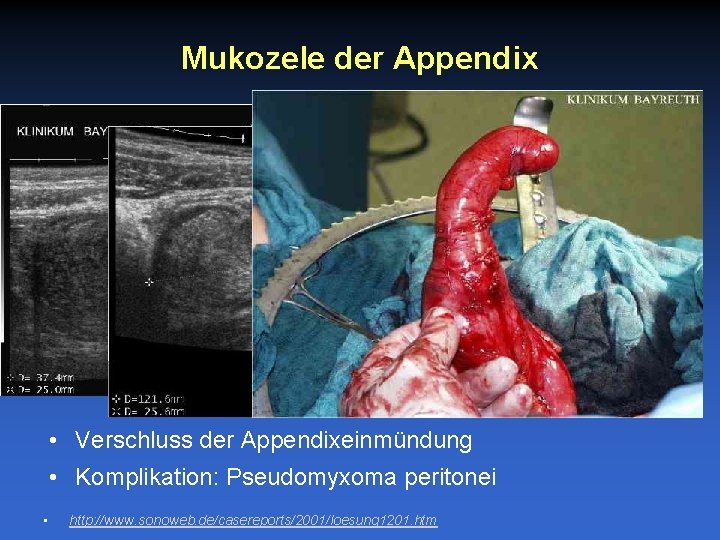 Mukozele der Appendix • Verschluss der Appendixeinmündung • Komplikation: Pseudomyxoma peritonei • http: //www.