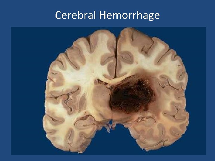 Cerebral Hemorrhage 