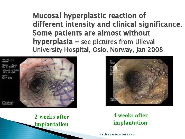 Mucosal hyperplastic reaction of different intensity and clinical significance. Some patients are almost without