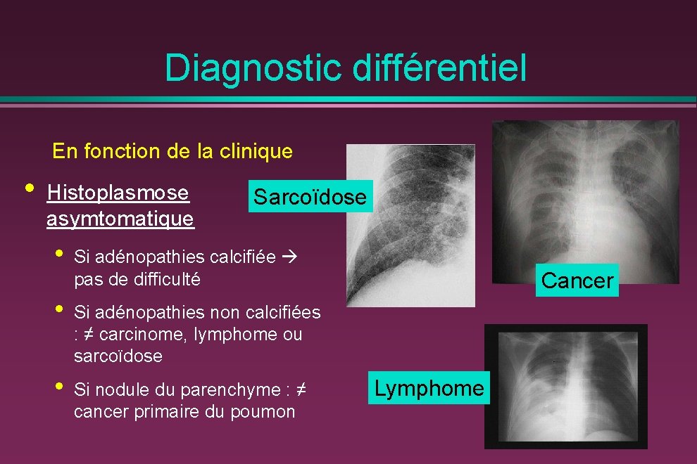 Diagnostic différentiel En fonction de la clinique • Histoplasmose asymtomatique Sarcoïdose • Si adénopathies