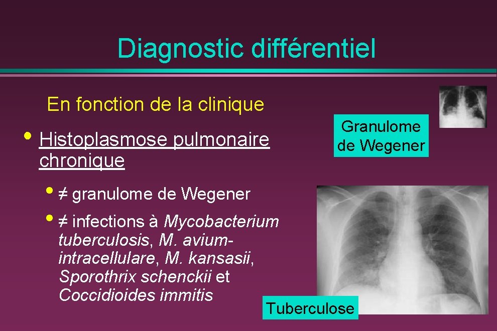 Diagnostic différentiel En fonction de la clinique • Histoplasmose pulmonaire chronique Granulome de Wegener