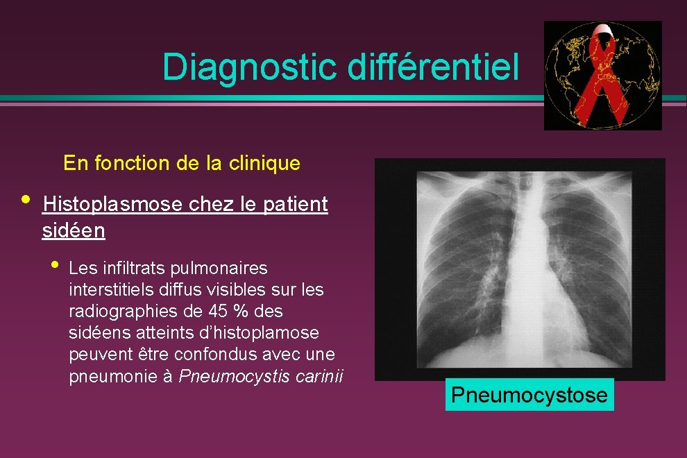 Diagnostic différentiel En fonction de la clinique • Histoplasmose chez le patient sidéen •