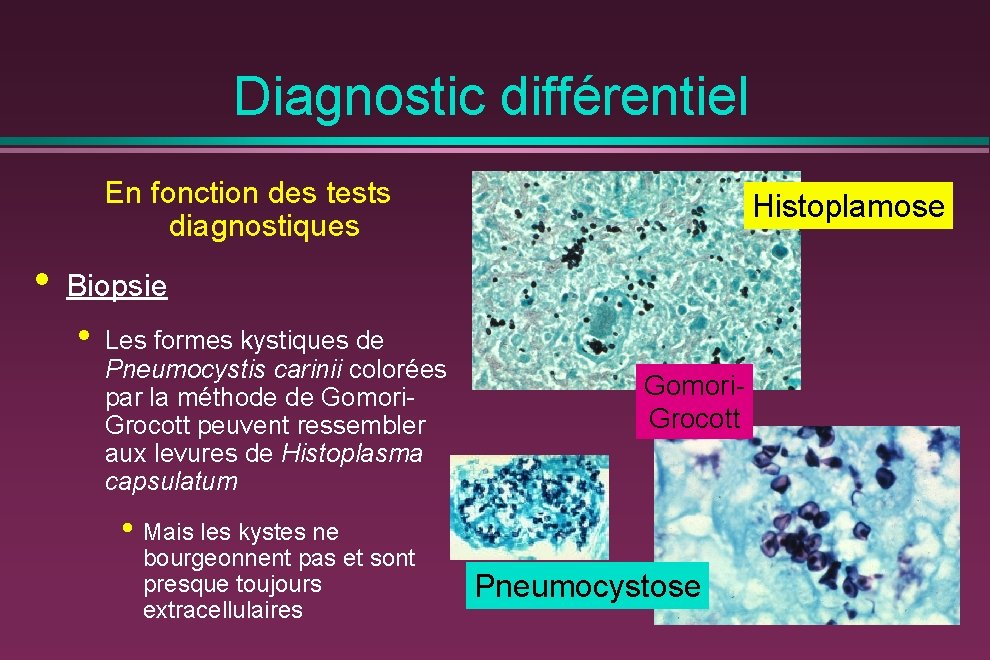 Diagnostic différentiel En fonction des tests diagnostiques • Histoplamose Biopsie • Les formes kystiques