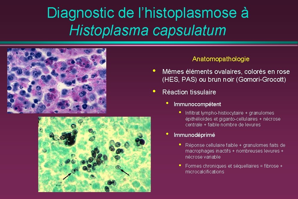 Diagnostic de l’histoplasmose à Histoplasma capsulatum Anatomopathologie • Mêmes éléments ovalaires, colorés en rose