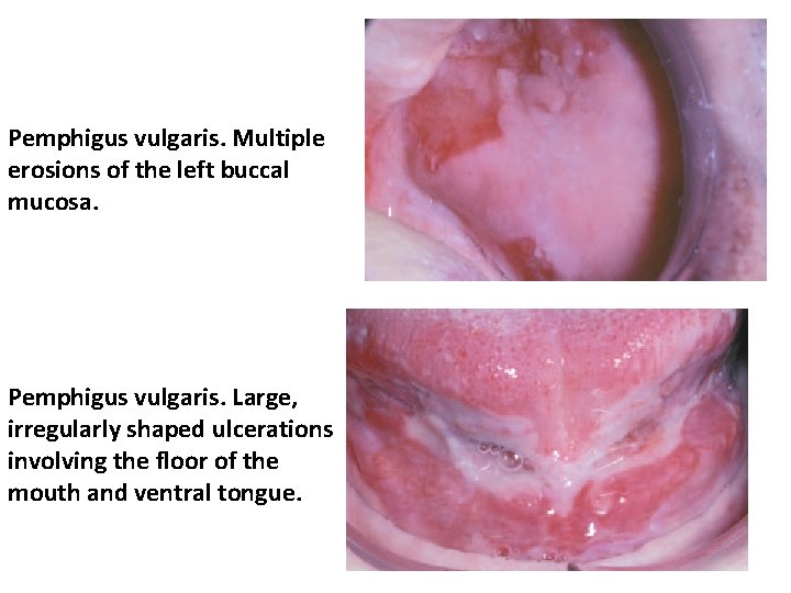 Pemphigus vulgaris. Multiple erosions of the left buccal mucosa. Pemphigus vulgaris. Large, irregularly shaped