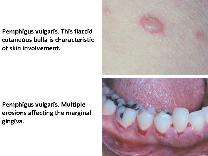 Pemphigus vulgaris. This flaccid cutaneous bulla is characteristic of skin involvement. Pemphigus vulgaris. Multiple