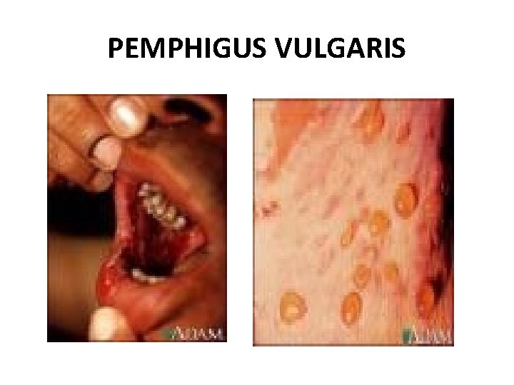 PEMPHIGUS VULGARIS 