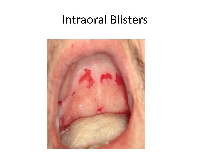 Intraoral Blisters 