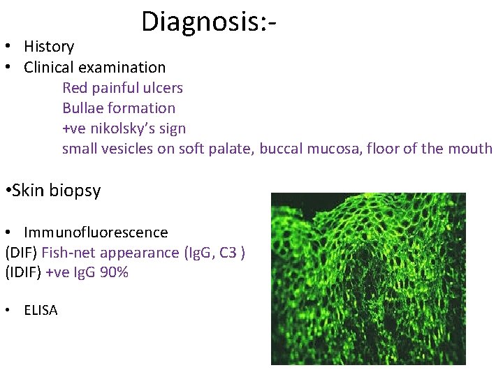 Diagnosis: - • History • Clinical examination Red painful ulcers Bullae formation +ve nikolsky’s
